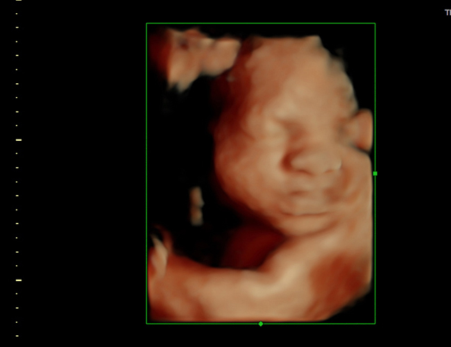 3D ultrasound image at 29 weeks